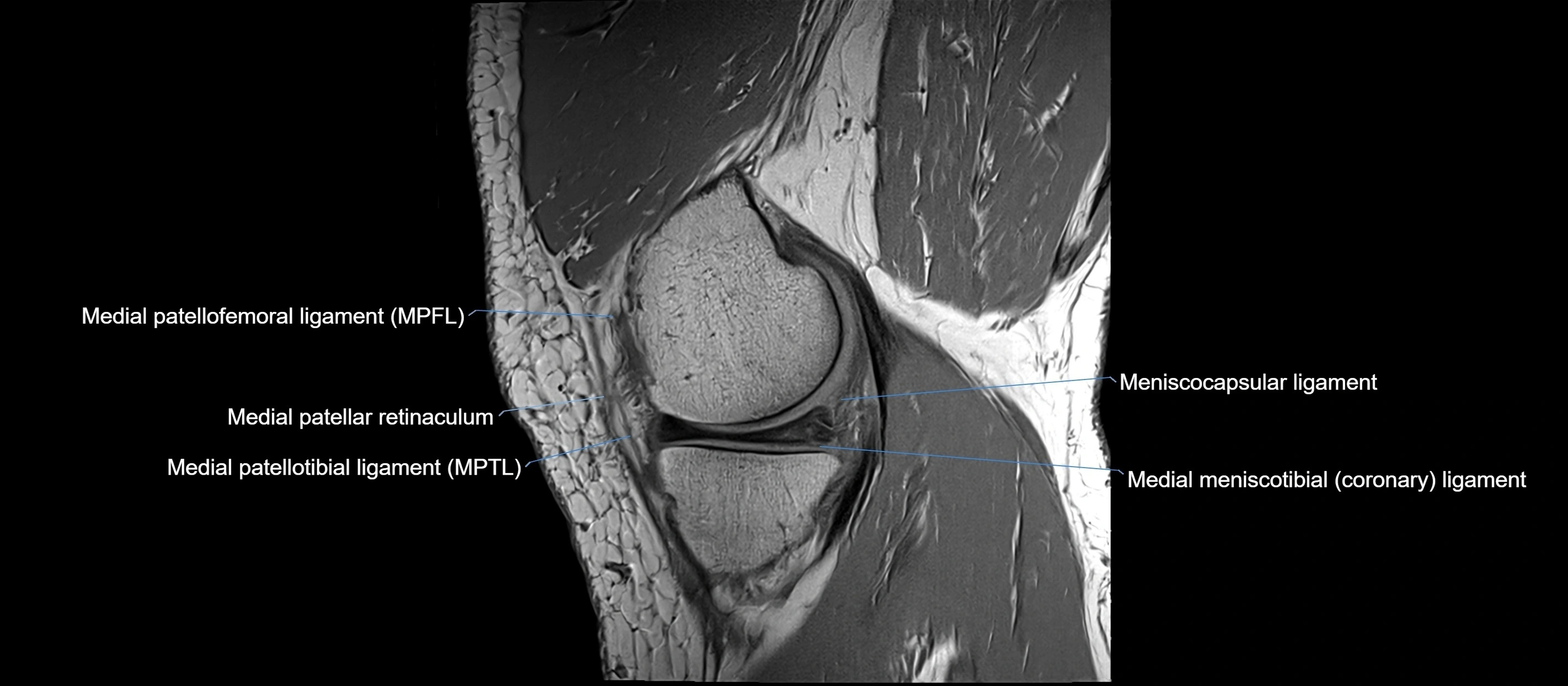 MRI sagittal  ligaments cross sectional anatomy 3T  radiology  image-img-00001-00013.webp